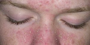 Conheça-4-causas-para-a-dermatite-seborreica