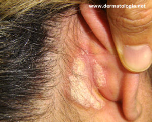 Dermatite-Seborreica-na-Orelha