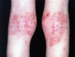 Dermatite atopica flexuras 2