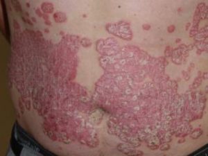 adultos-psoriase_627481173