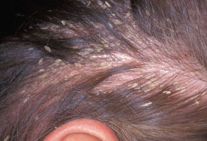 dermatite-seborreia