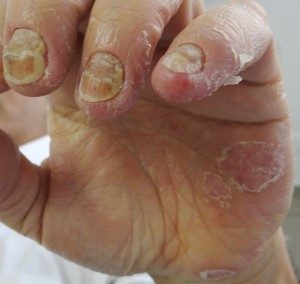 psoriase-unhas-300x284